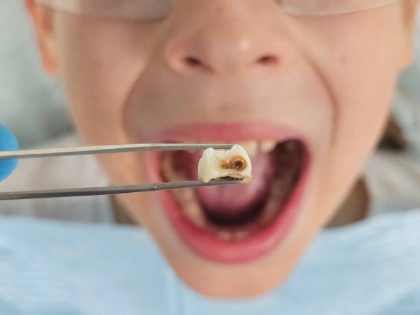 Best Broken or Cracked Tooth Emergency Dentist in San Buenaventura, CA
